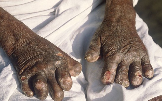 Leprosy Cases in Florida on the Rise; State New Hotspot For Disease [Report]