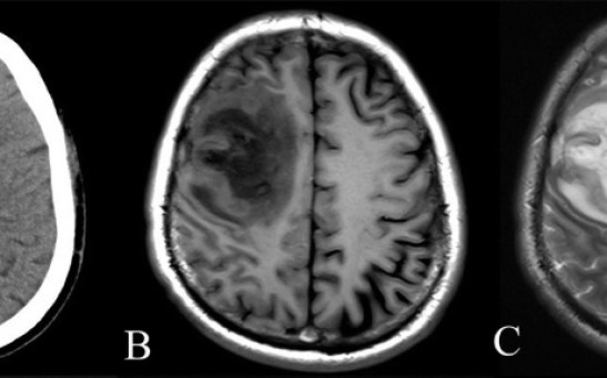 8-Centimeter Live Parasitic Roundworm Found in Australian Woman's Brain Who Complained About Forgetfulness, Depression