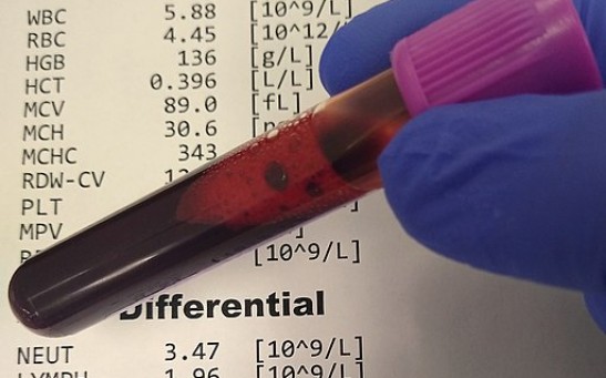What Level of RDW is Dangerous? Understanding the Blood Test and Interpreting the Results