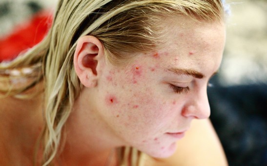 Acne Vaccine Neutralizes Bacterial Enzyme Hyaluronidase To Reduce Skin Inflammation 