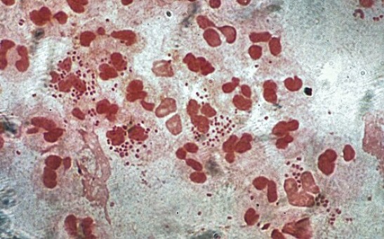 Super Gonorrhea: New Epidemic Feared as a Sexually Transmitted Infection Shows Total Resistance to Antibiotics