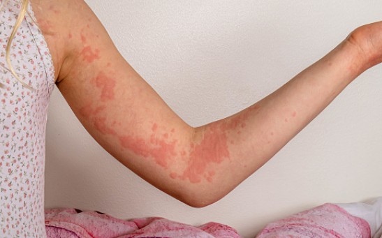 Cholinergic Urticaria: How Can a Person Be Allergic to Their Own Sweat?