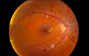 Hypertensive Retinopathy High Blood Pressure